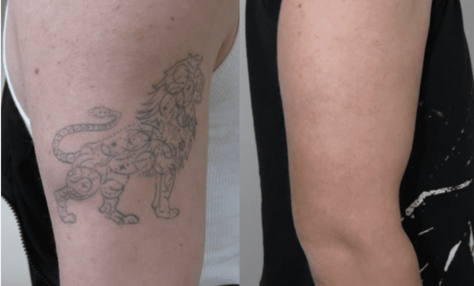 Före och efter tatueringsborttagning hos Efface Stockholm