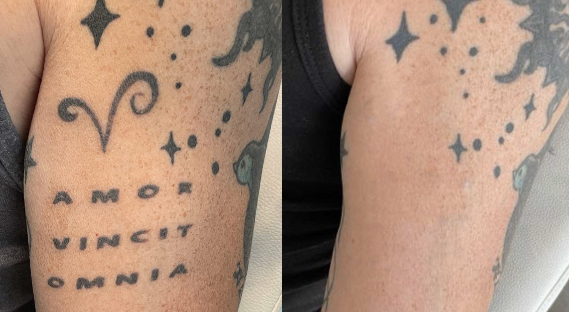 Före och efter tatueringsborttagning hos Efface Stockholm