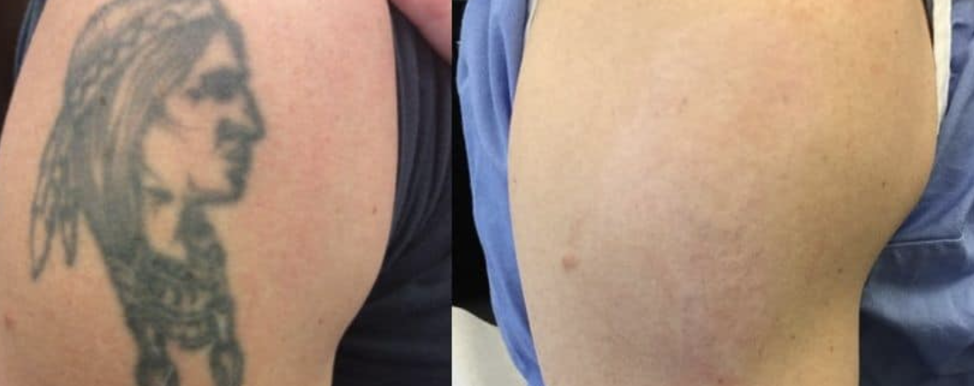 Före och efter tatueringsborttagning hos Efface Stockholm